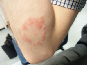 My arm showing a circle of ringworm